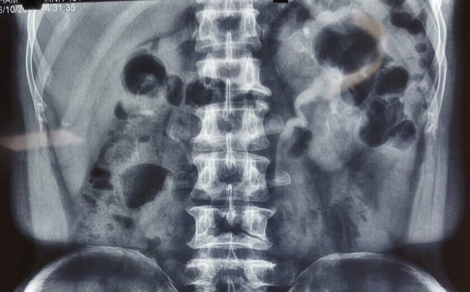 Hình ảnh chụp X.quang của bệnh nhân.