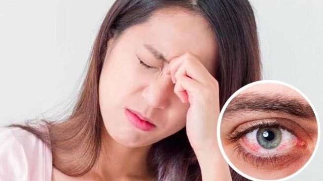 Viêm kết giác mạc mùa xuân là một dạng của viêm kết mạc dị ứng. Ảnh minh hoạ.