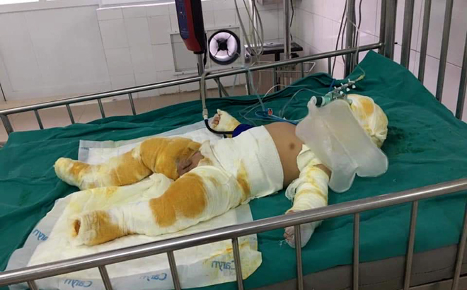 Cháu Nguyễn Hải Nam, con trai anh Mạnh bị bỏng nặng, đã được chuyển về Viện Bỏng Trung Ương

